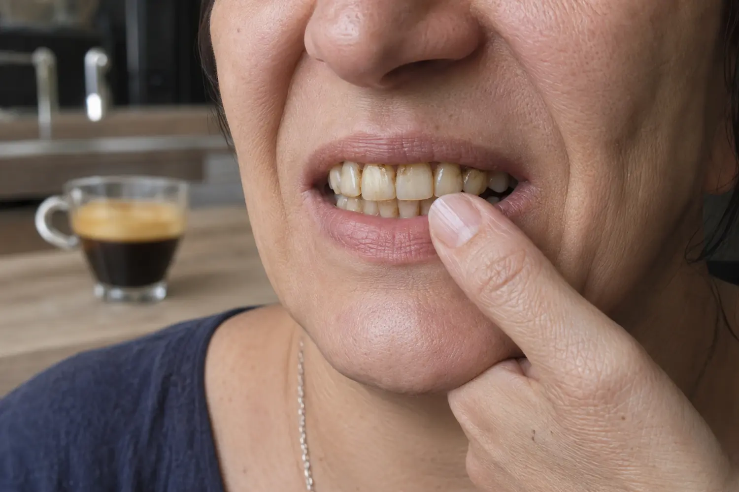 Macchie superficiali e ingiallimento visibili dopo il caffè